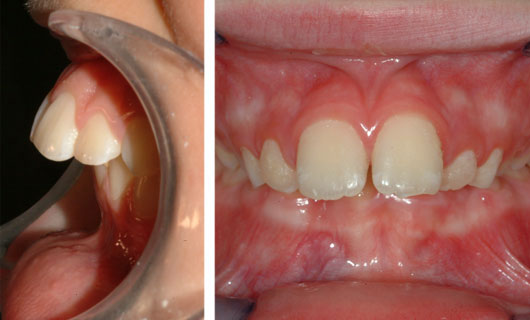 Ortodonzia Funzionale - Prima