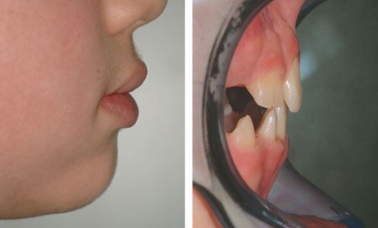 Ortodonzia Funzionale - Dopo