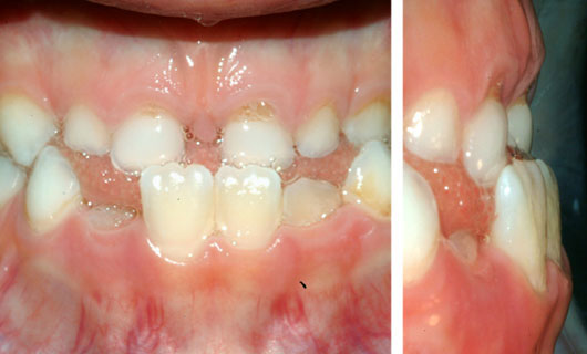 Ortodonzia Funzionale - Prima