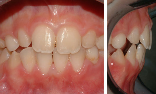 Ortodonzia Funzionale - Dopo
