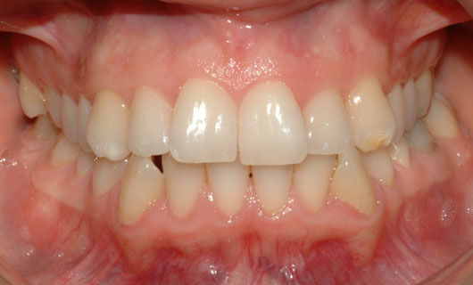 Ortodonzia Linguale - Prima