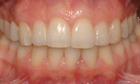 Ortodonzia Linguale - Dopo