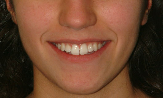 Ortodonzia Linguale - Prima