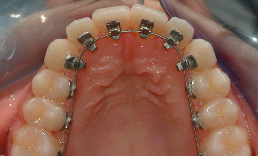 Ortodonzia Linguale