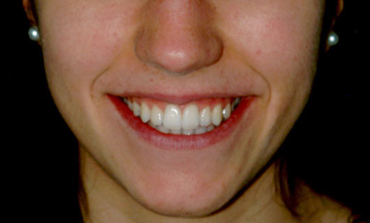 Ortodonzia Linguale - Dopo