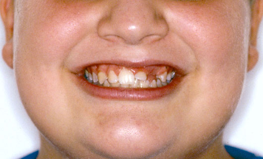 Ortodonzia Fissa - Prima