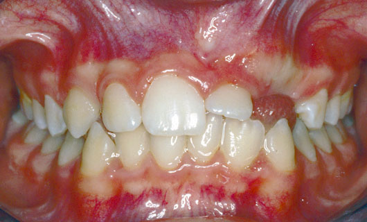 Ortodonzia Fissa - Prima
