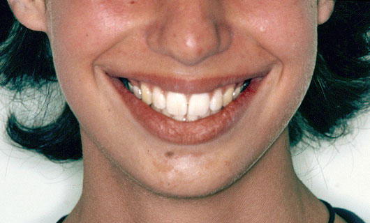 Ortodonzia Fissa - Dopo