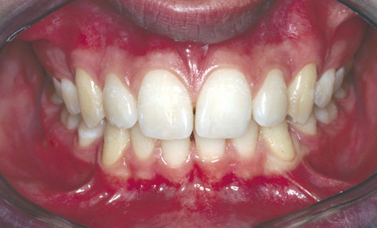 Ortodonzia Fissa - Dopo